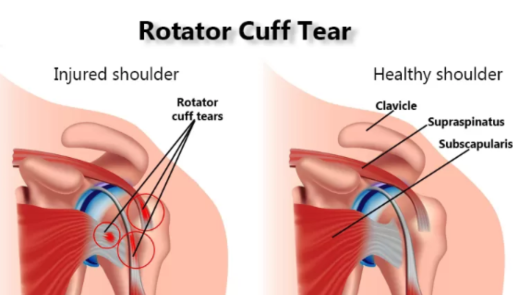 Rotator Cuff Tear
