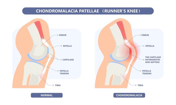 Chondromalacia Patellae Consultation with Dr. Jigar Desai