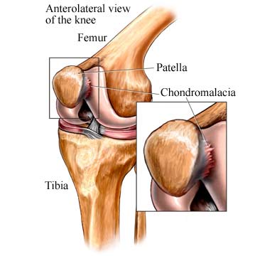 Chondromalacia Patellae Treatment by Dr. Jigar Desai