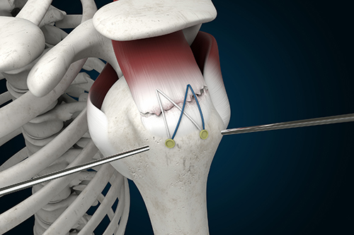 Rotator Cuff Tear